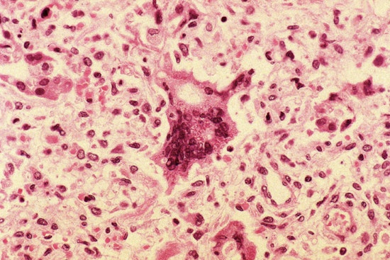 First Measles Cases of the Year Reported in Linn County Oregon as Health Officials Urge Vaccination and Caution