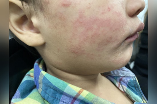 Measles Alert in Gaston County, NC as Health Officials Urge Vigilance After Exposure at Local Restaurant and Christmas Town USA