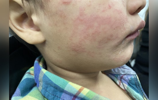 Measles Alert in Gaston County, NC as Health Officials Urge Vigilance After Exposure at Local Restaurant and Christmas Town USA