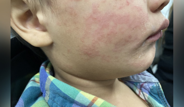 Measles Alert in Gaston County, NC as Health Officials Urge Vigilance After Exposure at Local Restaurant and Christmas Town USA