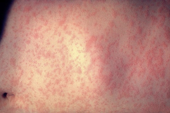 Measles Cases Rise in North Carolina Following South Carolina Outbreak as Health Officials Urge Vaccination