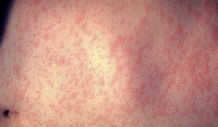 Measles Cases Rise in North Carolina Following South Carolina Outbreak as Health Officials Urge Vaccination