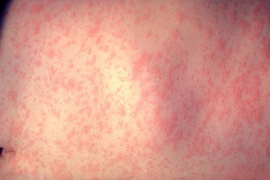 Measles Outbreak in Cuyahoga County Linked to Unvaccinated Children, Health Officials Urge Immunization Amid Rising Cases