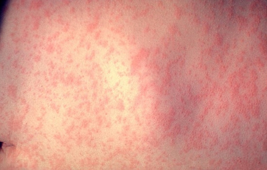 Measles Outbreak in Cuyahoga County Linked to Unvaccinated Children, Health Officials Urge Immunization Amid Rising Cases
