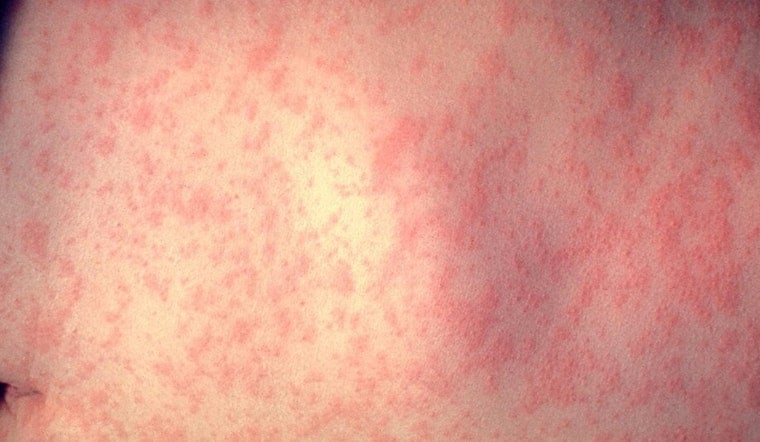 Measles Outbreak in Cuyahoga County Linked to Unvaccinated Children, Health Officials Urge Immunization Amid Rising Cases