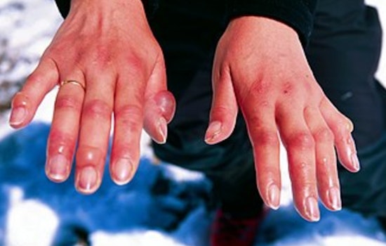 St. Louis Health Department Warns of Frostbite Risks, Urges Precautions during Frigid January Weather