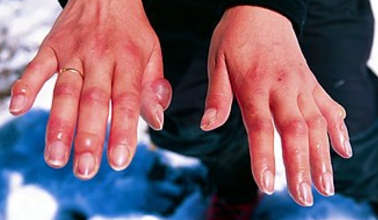 St. Louis Health Department Warns of Frostbite Risks, Urges Precautions during Frigid January Weather
