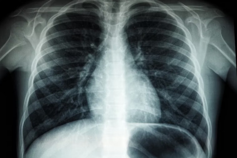 TB Scare Shakes Riordan High As Three Cases Tied To Campus
