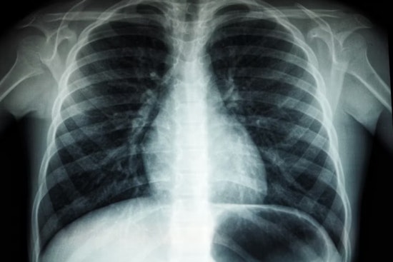 TB Scare Shakes Riordan High As Three Cases Tied To Campus