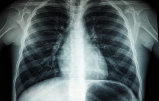 TB Scare Shakes Riordan High As Three Cases Tied To Campus