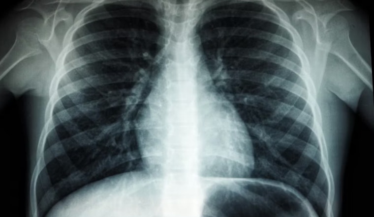 TB Scare Shakes Riordan High As Three Cases Tied To Campus