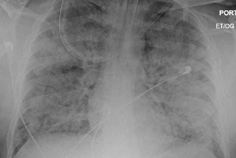 North Texas Woman Shares Survival Story After Rare Vasculitis