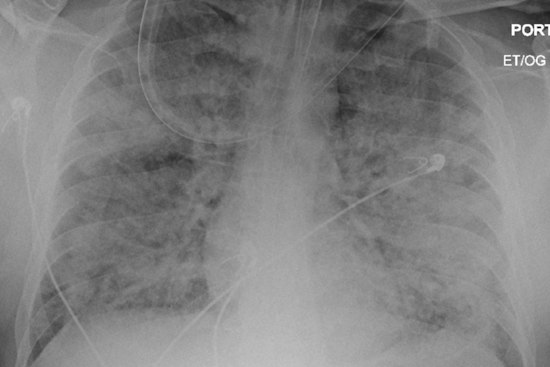 North Texas Woman Shares Survival Story After Rare Vasculitis