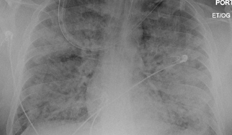 North Texas Woman Shares Survival Story After Rare Vasculitis