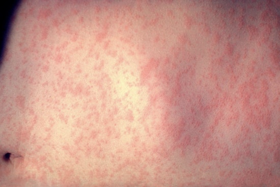 Measles Outbreak Hits Duval as Five Children Fall Ill and Health Officials Rush to Contain It