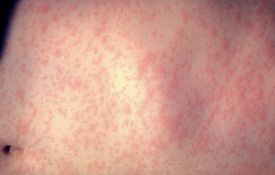 Measles Outbreak Hits Duval as Five Children Fall Ill and Health Officials Rush to Contain It