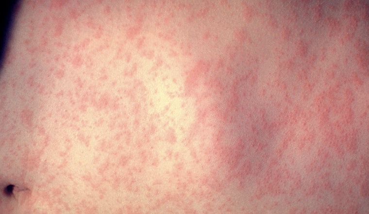 Measles Outbreak Hits Duval as Five Children Fall Ill and Health Officials Rush to Contain It