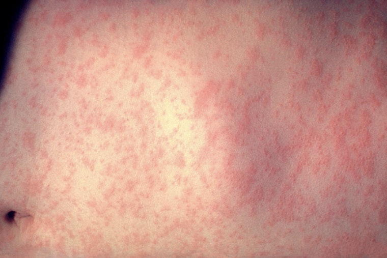 Measles Scare Hits Downtown Bethesda Office After Visit From Virginia Patient