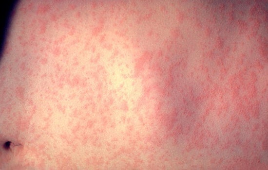 Measles Scare Hits Downtown Bethesda Office After Visit From Virginia Patient