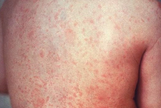 Measles Scare Puts Philly Flyers On Alert At PHL Terminal E