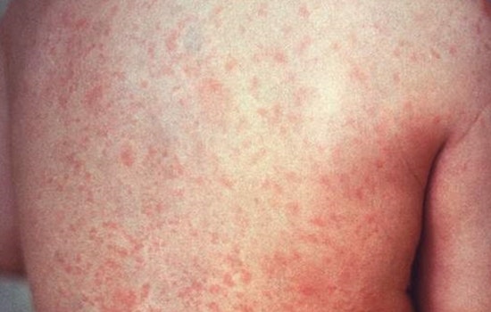 Measles Scare Puts Philly Flyers On Alert At PHL Terminal E