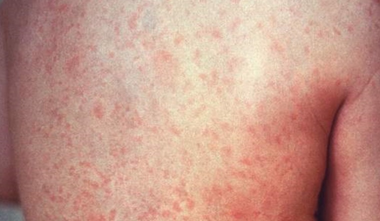 Measles Scare Puts Philly Flyers On Alert At PHL Terminal E