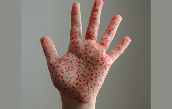 Measles Strikes Rockwall County Home as Officials Race to Contain It