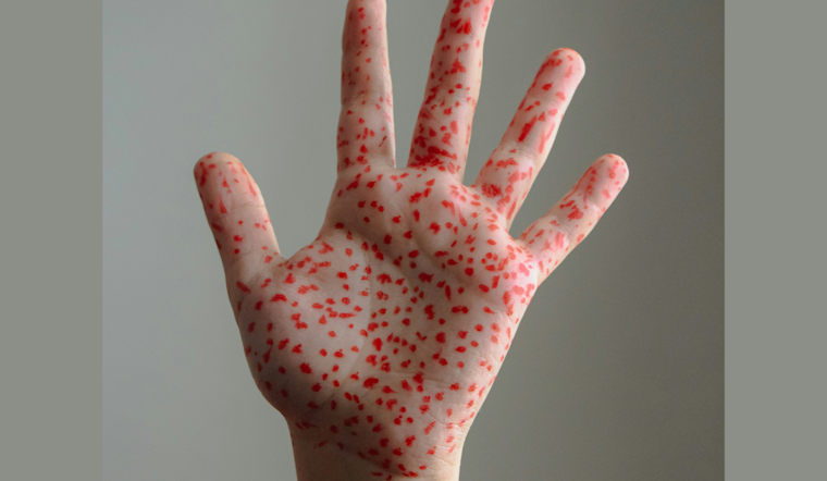 Measles Strikes Rockwall County Home as Officials Race to Contain It