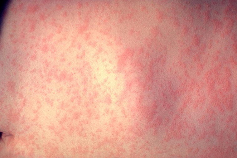 NYC Health Officials Investigate Measles Case in Unvaccinated Infant and Urge MMR Vaccination