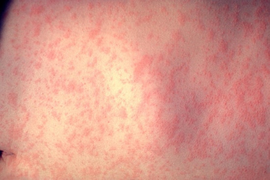 NYC Health Officials Investigate Measles Case in Unvaccinated Infant and Urge MMR Vaccination