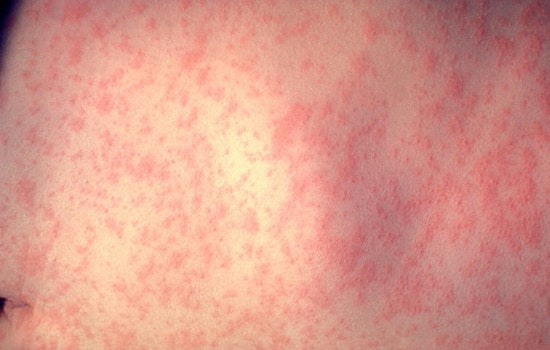 NYC Health Officials Investigate Measles Case in Unvaccinated Infant and Urge MMR Vaccination