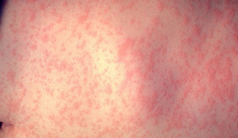 NYC Health Officials Investigate Measles Case in Unvaccinated Infant and Urge MMR Vaccination