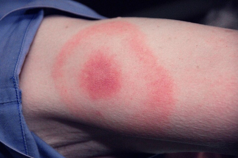 Ohio Faces Rising Lyme Disease Threat Comparable to Connecticut, Ohio State University Study Finds