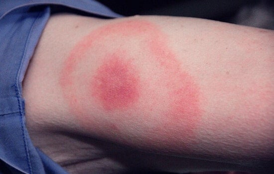 Ohio Faces Rising Lyme Disease Threat Comparable to Connecticut, Ohio State University Study Finds