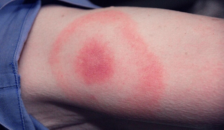 Ohio Faces Rising Lyme Disease Threat Comparable to Connecticut, Ohio State University Study Finds