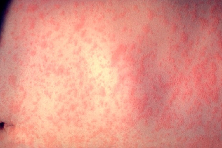 Second Measles Case of the Year Confirmed in Dane County Wisconsin as Health Officials Remain on Alert