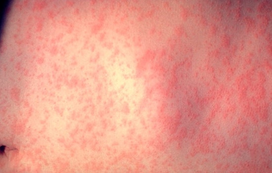 Second Measles Case of the Year Confirmed in Dane County Wisconsin as Health Officials Remain on Alert
