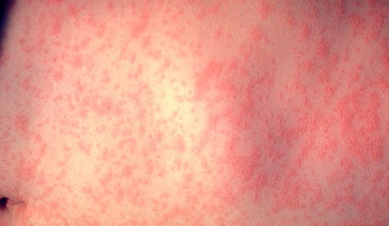 Second Measles Case of the Year Confirmed in Dane County Wisconsin as Health Officials Remain on Alert