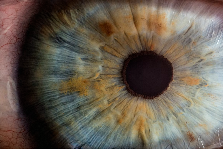 ‘Tiny Eye Chip’ Lets Pittsburgh Woman Read Again After Macular Degeneration Ordeal