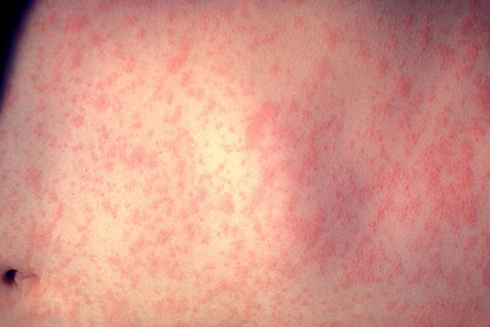 Unvaccinated Baby Back From Overseas Is NYC's First Measles Case Of 2026