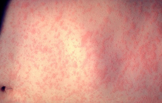 Unvaccinated Baby Back From Overseas Is NYC's First Measles Case Of 2026