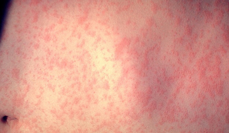 Unvaccinated Baby Back From Overseas Is NYC's First Measles Case Of 2026