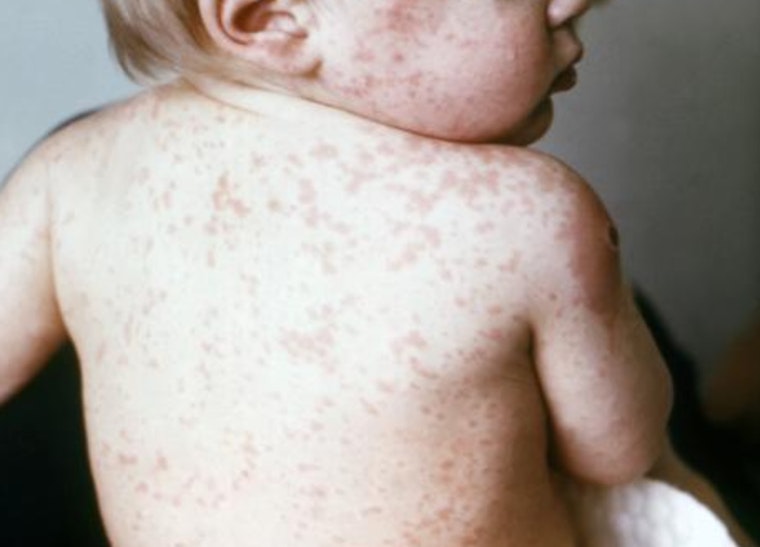 7-Year-Old Dies Of Measles-Linked Brain Disease In Orange County