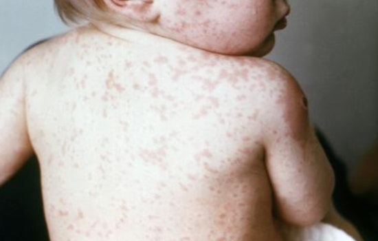 7-Year-Old Dies Of Measles-Linked Brain Disease In Orange County