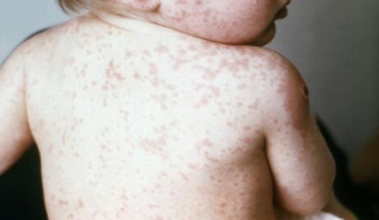 7-Year-Old Dies Of Measles-Linked Brain Disease In Orange County