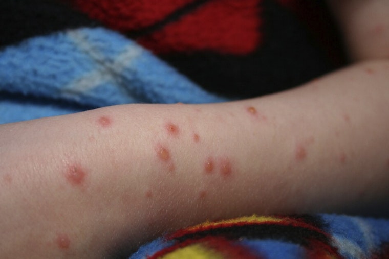 Chickenpox Outbreak Boots Unvaccinated Kids From St. Louis’ Principia School