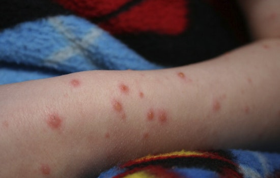 Chickenpox Outbreak Boots Unvaccinated Kids From St. Louis’ Principia School