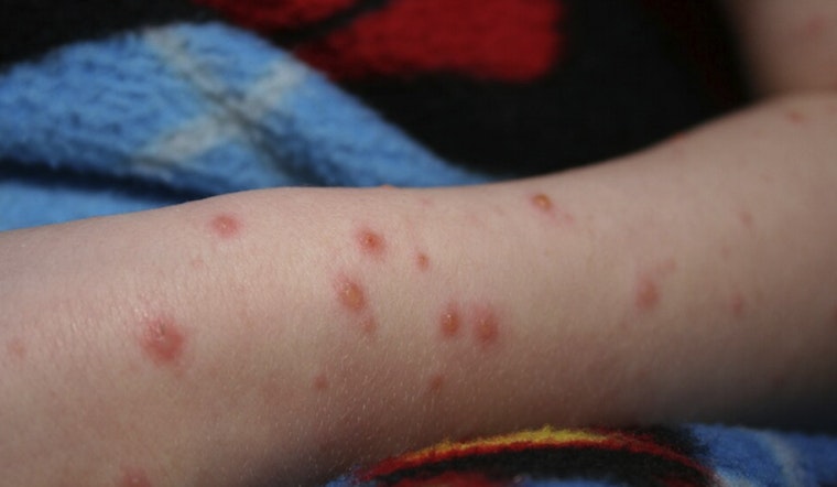 Chickenpox Outbreak Boots Unvaccinated Kids From St. Louis’ Principia School
