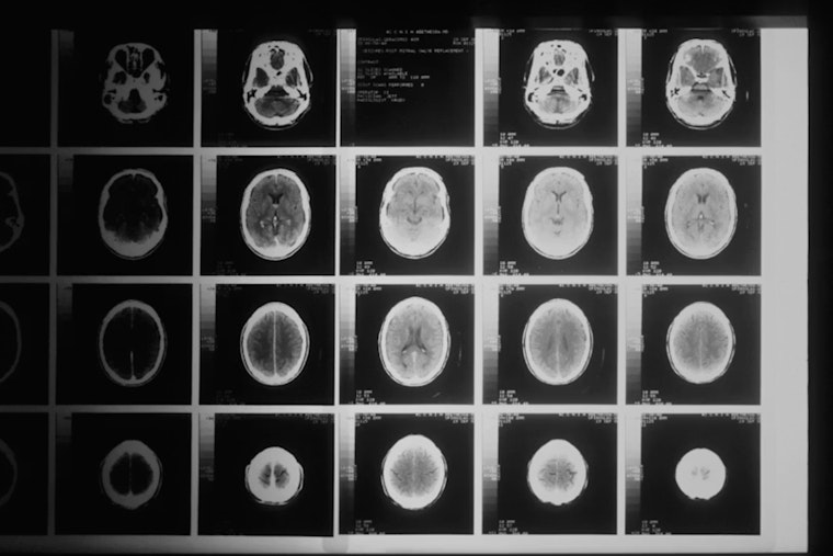 Cleveland Lab’s ‘Brain Shield’ Drug Shows Radiation Hope in Mice
