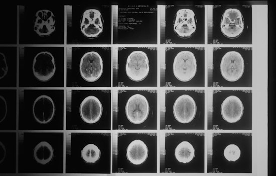 Cleveland Lab’s ‘Brain Shield’ Drug Shows Radiation Hope in Mice